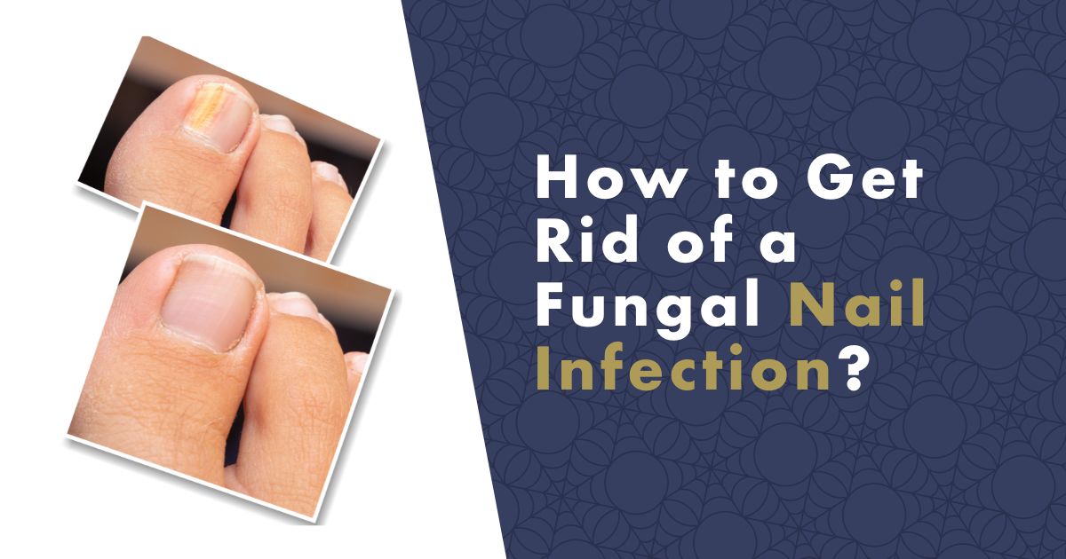 How to Get Rid of a Fungal Nail Infection-fb (1)